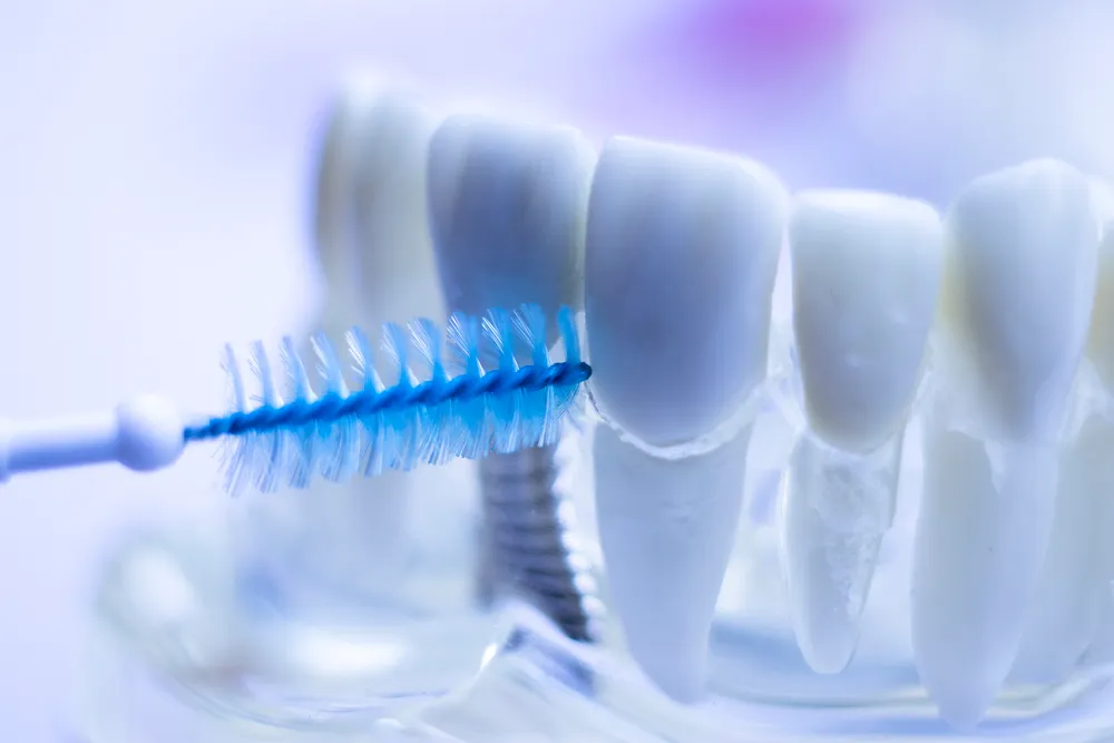 Lợi ích của bàn chải kẽ răng cho răng